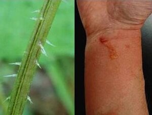 （左）イラクサの刺毛<br />（右）イラクサによる接触性皮膚炎
